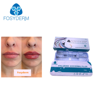 唇のための1ml Hyaluronic酸の注入のFosydermの皮膚注入口