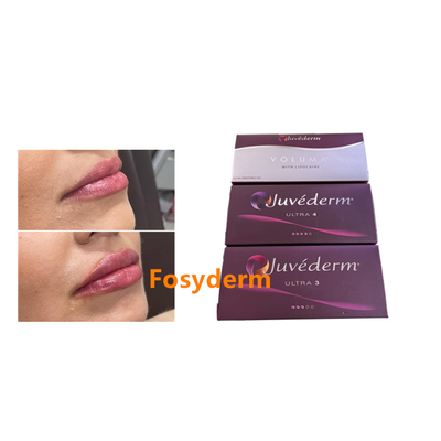 Juvederm 2*1ml ヒアルロン酸 皮膚充填剤 唇増強 下 Chin 増殖