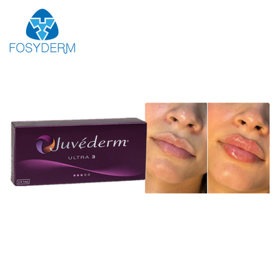 Juvederm 2*1ml ヒアルロン酸 皮膚充填剤 唇増強 下 Chin 増殖