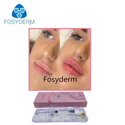唇の強化のためのFosydermの美学1mlのHyaluronic酸の注入の皮膚注入口
