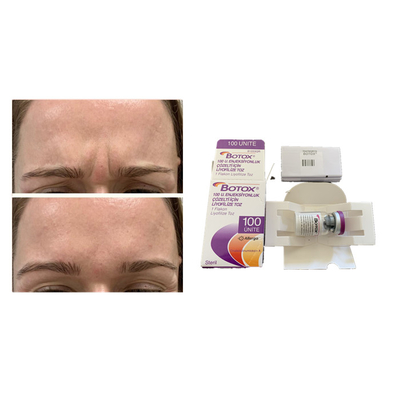 Allerganの白いボツリヌス菌の毒素の反老化するの注入