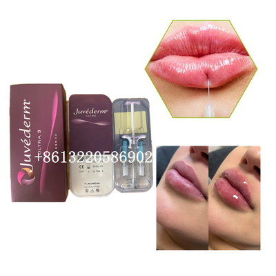 Ultra3 Juvedermの唇の注入口の注入2mlのHyaluronic酸の皮膚