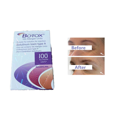 Allergan の注入のボツリヌス菌の毒素100の単位の額のしわ