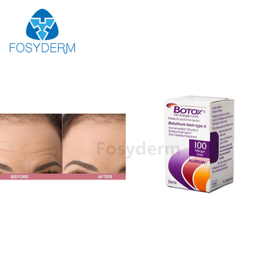 100単位のAllergan の反しわのためのボツリヌス菌の毒素の注入