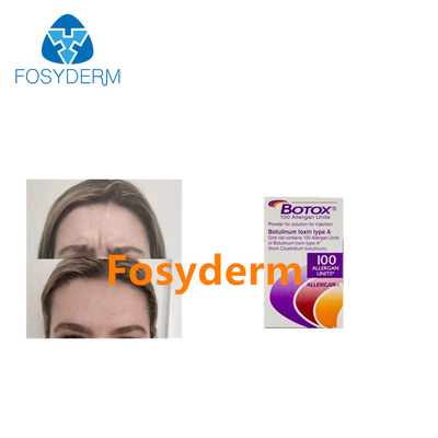 100単位のAllergan の反しわのためのボツリヌス菌の毒素の注入