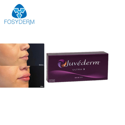 Juvederm Ultra3 2mlの十字は皮膚唇の注入口のHyaluronic酸の注入をつないだ