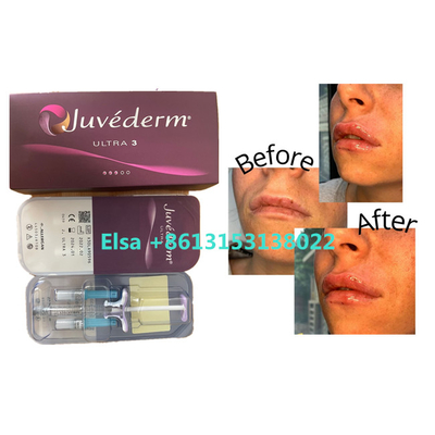 表面唇のための化粧品プロダクトJuvedermの皮膚注入口