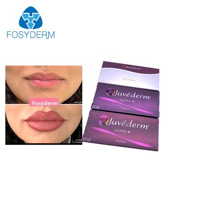 Juvederm Ultra3の唇の強化のHyaluronic酸の皮膚注入口2x1.0ml