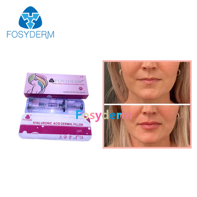 Fosyderm 2mlの皮膚唇の注入口のHyaluronic酸の唇の強化の注入のDermライン
