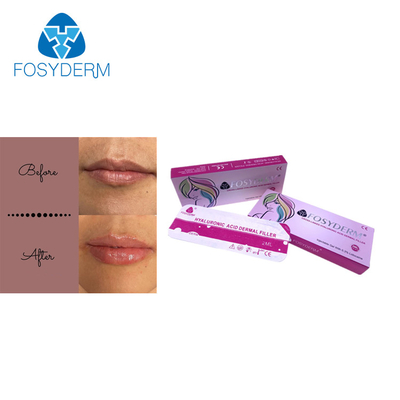 Fosyderm 2mlの皮膚唇の注入口のHyaluronic酸の唇の強化の注入のDermライン