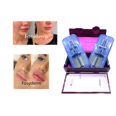 Juvederm ヒアルロン酸 皮膚充填剤 アンチエイジング 2*1ml 顔充填剤