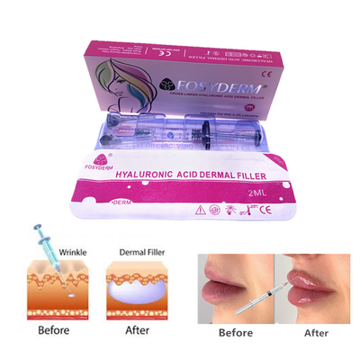 Fosyderm 2ml ヒアルロン酸ジェル 皮膚充填剤 注射 顔や鼻のケア