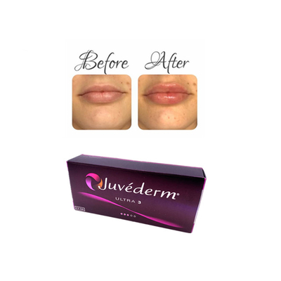 Juvederm インジェクタブル ヒアルロン酸 皮膚フィルラージェル