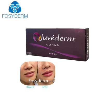 Juvederm超3つの1つのMl * 2つのHyaluronic酸の皮膚注入口の唇の注入