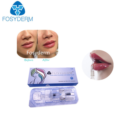 女性のための1ml hyaluronic酸の唇の注入口のDermの唇の強化の注入