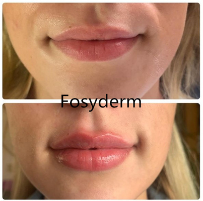 1.1ml Dermの皮膚唇の注入口のHyaluronic酸の注射可能な表面注入口