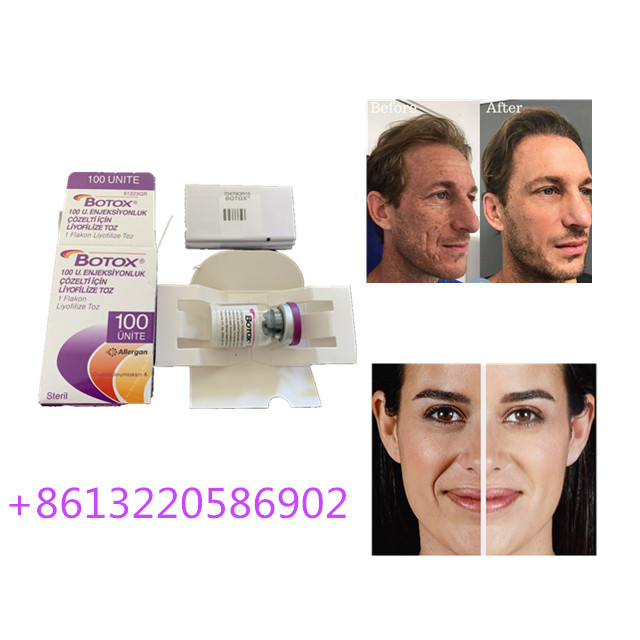 Allergan反老化するの注入100unitsは反しわをタイプする
