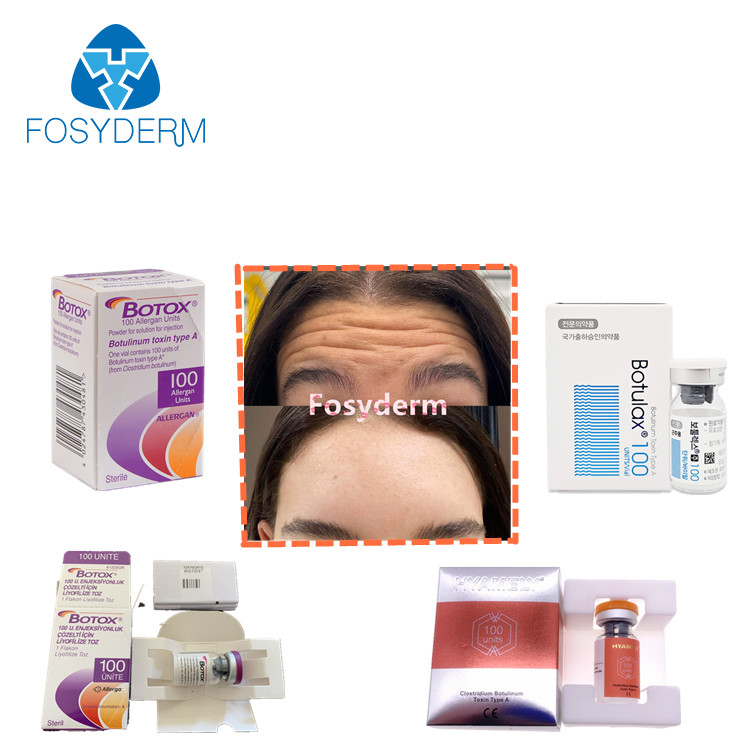 100units TypeAのボツリヌス菌の毒素の注入の反しわ Allergan