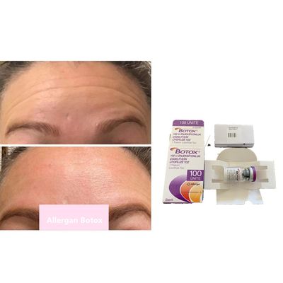 しわの取り外し100units Allergan のボツリヌス菌の毒素の粉の注入