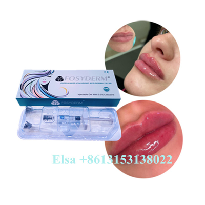 Hyaluronic酸のゲルの注入のJuvedermの唇の注入口のセリウム反老化する1ml 2ml 5ml