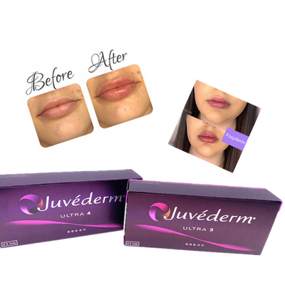 Hyaluronic酸の皮膚ゲルの注入のJuvedermの唇の注入口のセリウム反老化する2ml