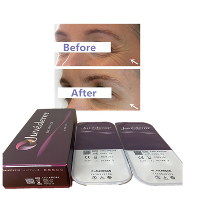 Juvederm 2ml Ultra3 Ultra4 VolumaのHyaluronic酸の皮膚注入口の唇の注入口24mg