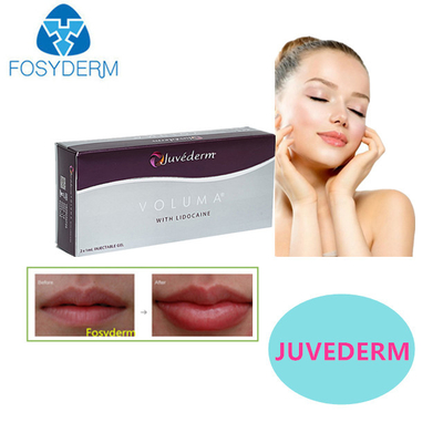 Juvederm ヒアルロン酸 皮膚充填剤 セクシーな唇 24MG 顔充填剤