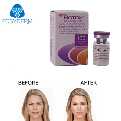 Allergan Botox 注射 100 単位 しわ除去用