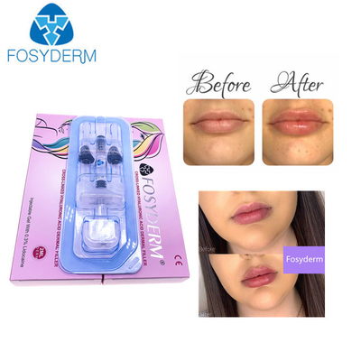 セリウムの証明1mlの唇のための深いHyaluronic酸Derm HAの皮膚注入口