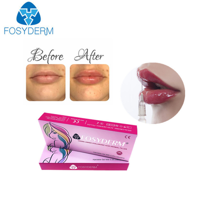 女性のための1ml hyaluronic酸の唇の注入口のDermの唇の強化の注入