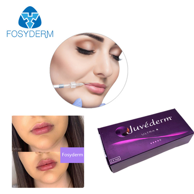 Ultra3 Ultra4 VolumaのHyaluronic酸の皮膚注入口のゲルのJuvedermの唇の注入口24mg/Ml