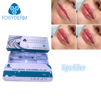 満ちる表面注入のFosyderm FosydermのHyaluronic酸の唇の注入口1ml