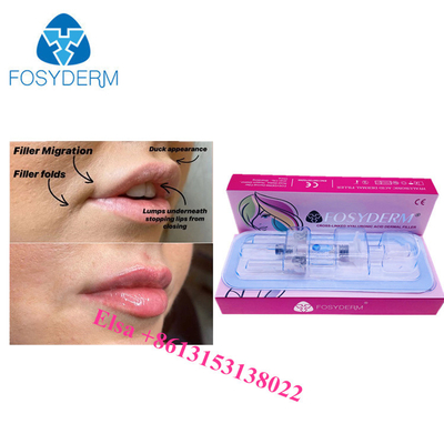唇 頬 鼻 唇 皮膚 フィルラー ヒアルロン酸 ハ 注射 1ml 2ml 5ml